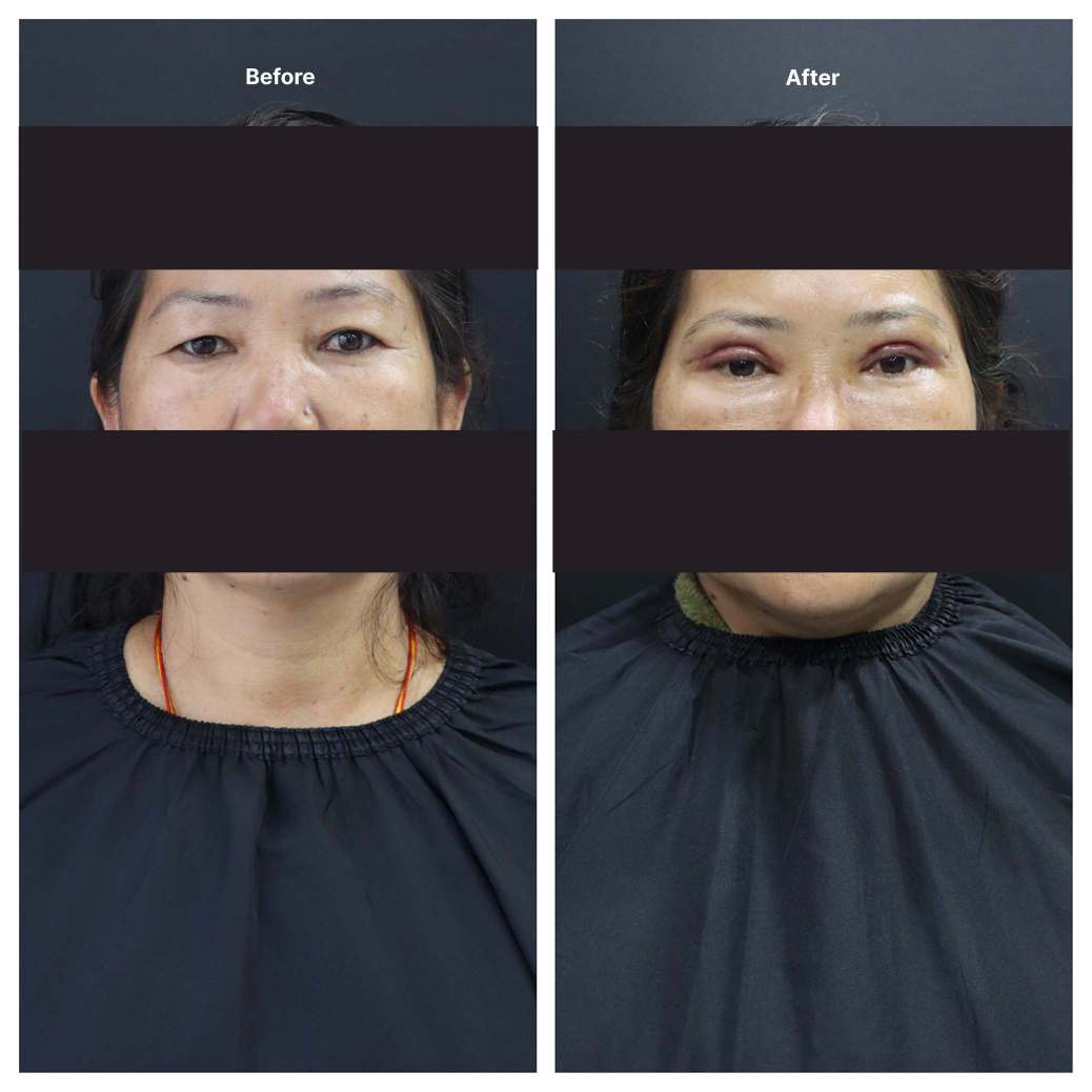 Eyelid Surgery KOQ10